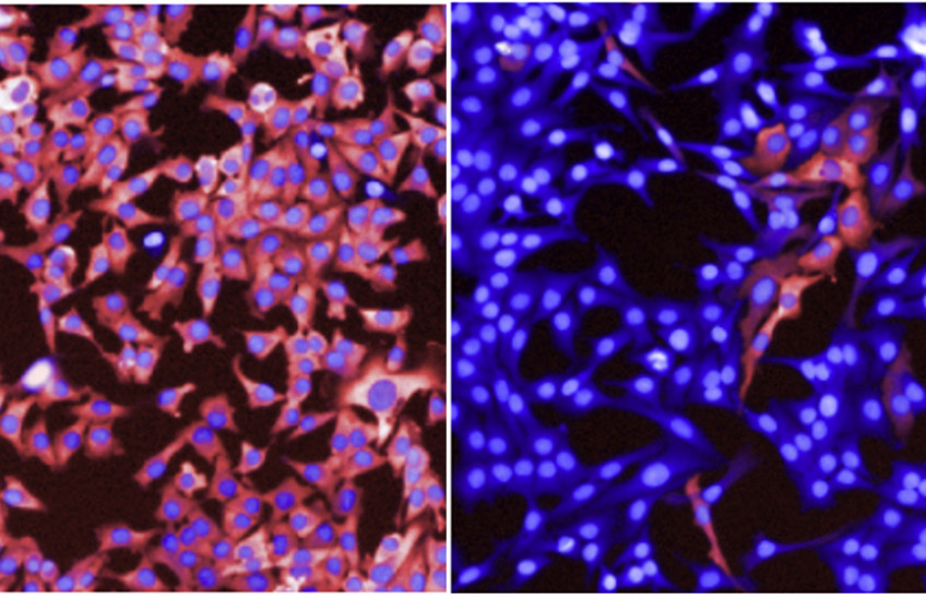 melanoma