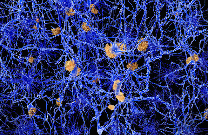 Alzheimer disease, neuron network with amyloid plaques
