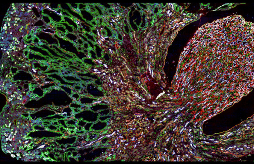build up of misfolded MUC1-fs protein