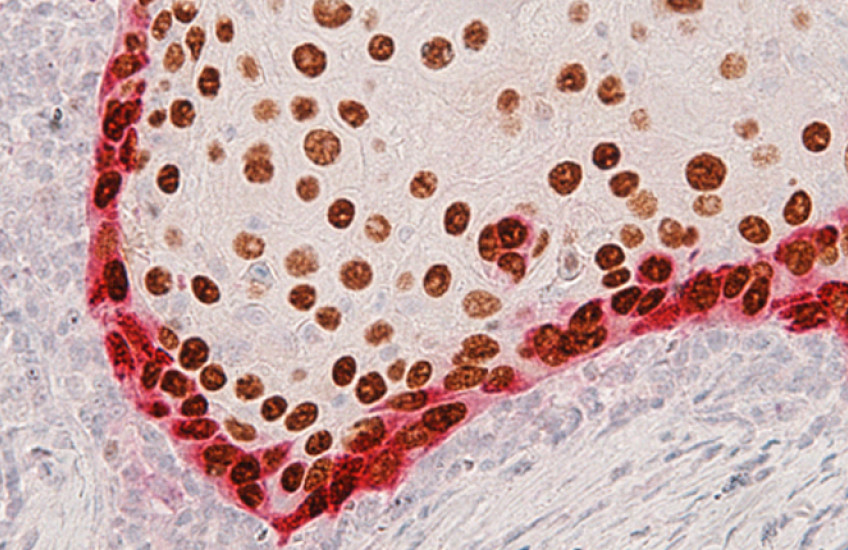 Researchers have compiled the first atlas of invasive head and neck tumor cells