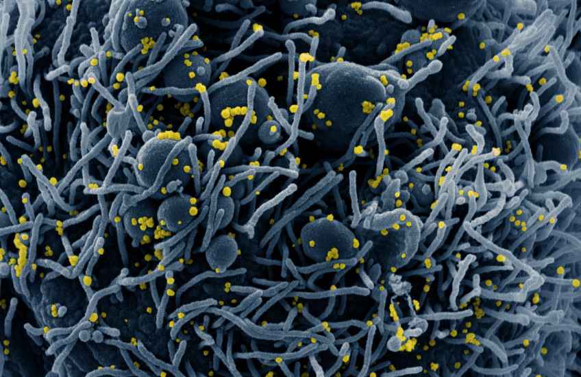 Electron microscopy image of SARS-CoV-2 tinted blue