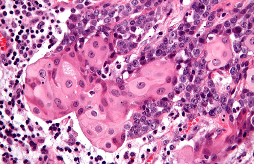 Purple and pink stains show abnormal cells