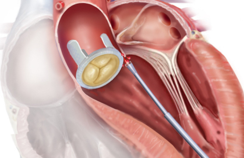 Illustration shows a tube entering a heart and approaching a leaky valve