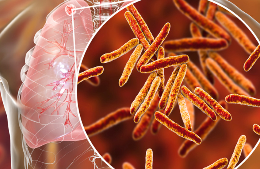secondary tb in lunch and close-up of tb bacteria