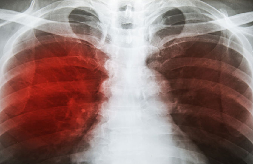 X-ray of infected lungs