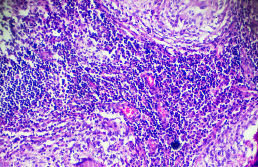 Tuberculosis pathological sample under microscope