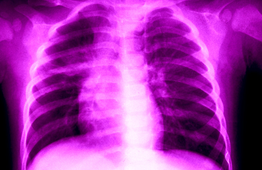 Colorized x-ray image of lungs.