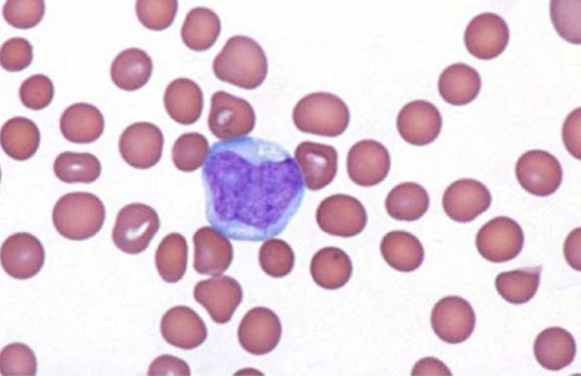 Pink-stained cells on a white background are interrupted by one misshapen purple-stained cell