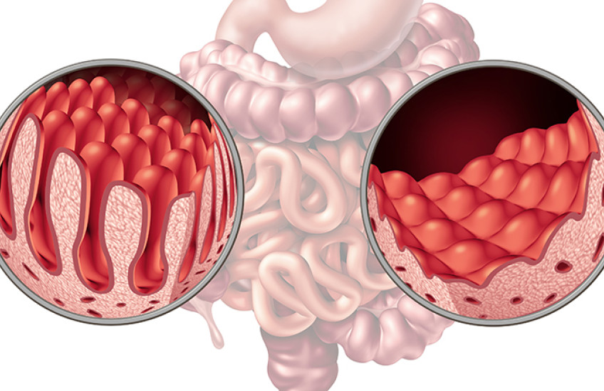 normal and damaged villi from celiac