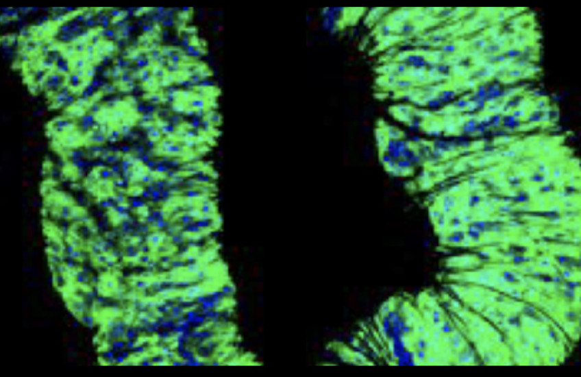 Microscopic image of cancer cells in fly gut