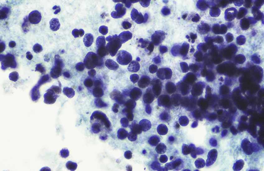 Cancer cells show as purple circles against blue tissue