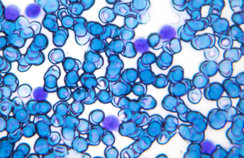 leukemia cells