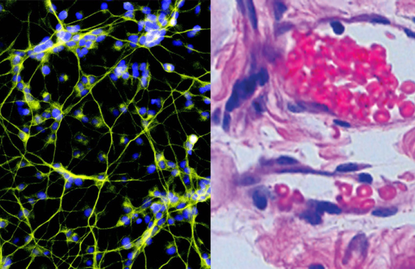 Combined image of two micrographs. On left, web of yellow threads with blue nuclei against a black background. On right, swirls of pink and purple stained cells on a gray background.
