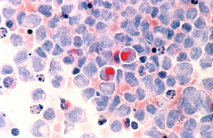 Human cells with acute myelocytic leukemia (AML) in the pericardial fluid, shown with an esterase stain at 400x