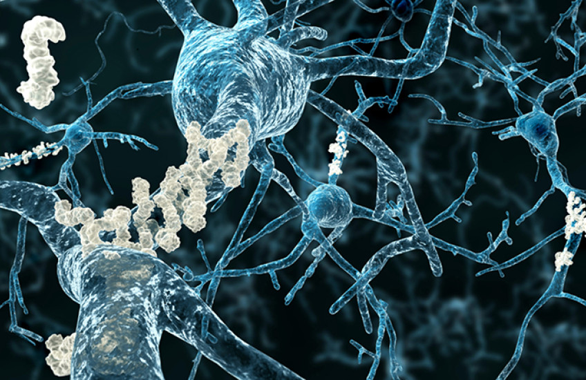 neurons with amyloid plaques