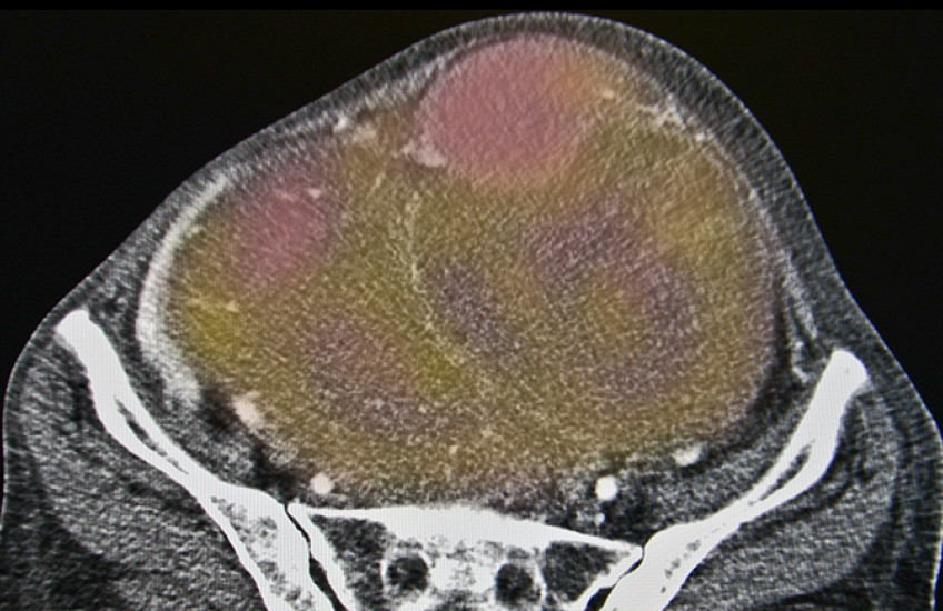 ovarian cancer image