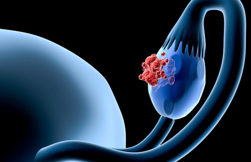 illustration of ovarian cancer