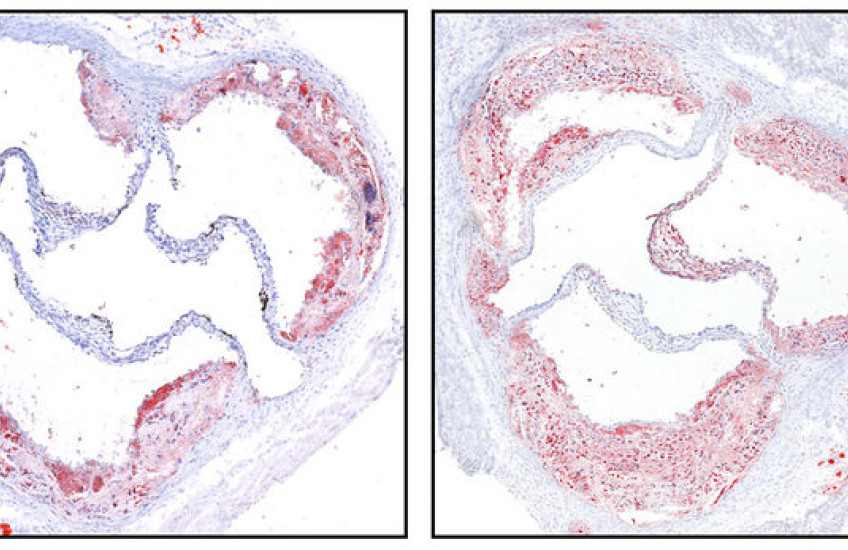 athlerosclerosis