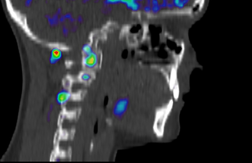 An image of a person’s head and neck showing normal tissue in black and white tones and inflammation in bright colors.