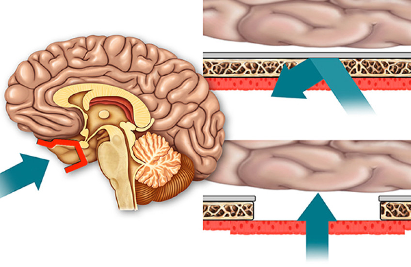 Bypassing the Blood-Brain Barrier