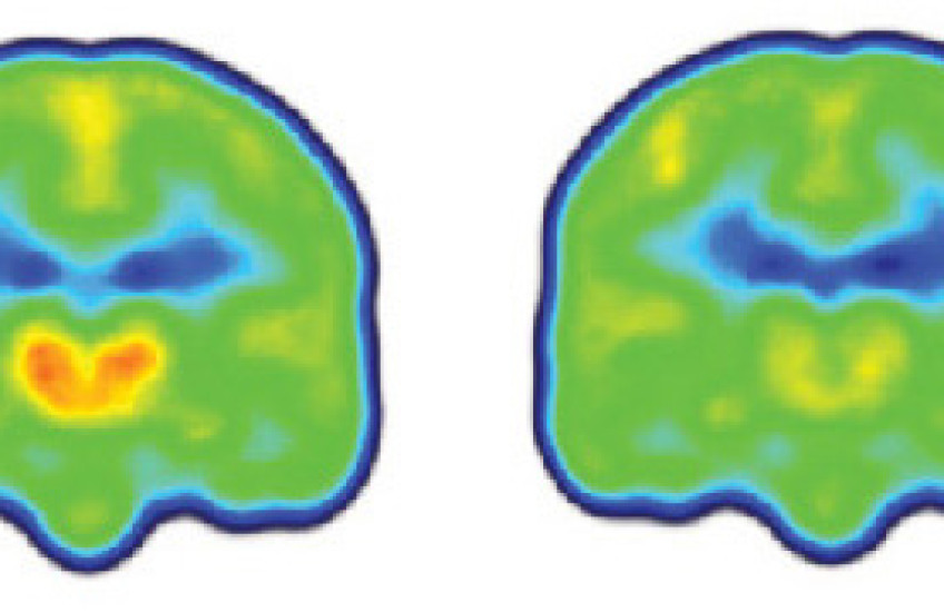 Pain in the Brain
