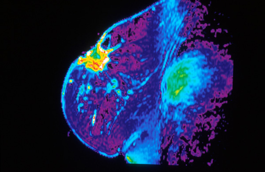 Breast Cancer Switchbacks