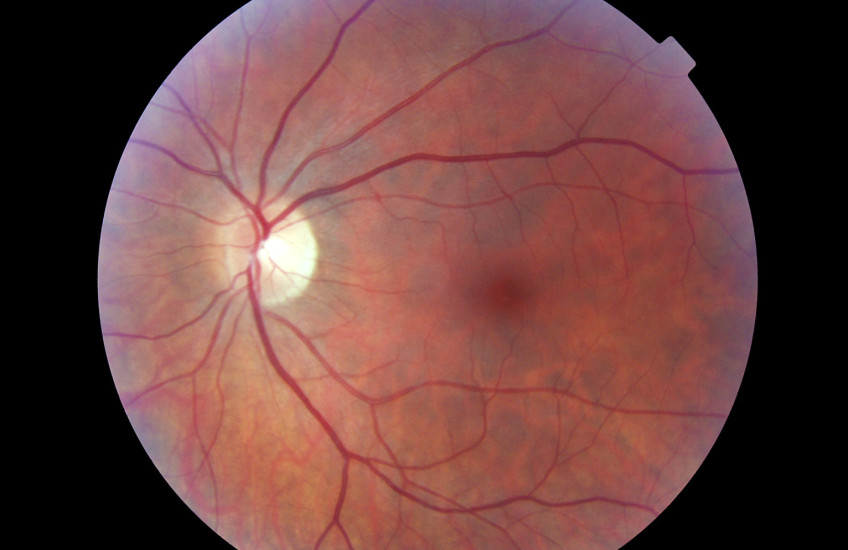 Bicarbonate for Better Vision?