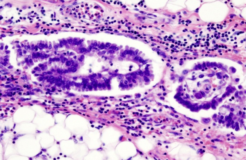 Delivering Hope in Ovarian Cancer