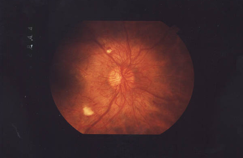 Eyedrop Therapy 