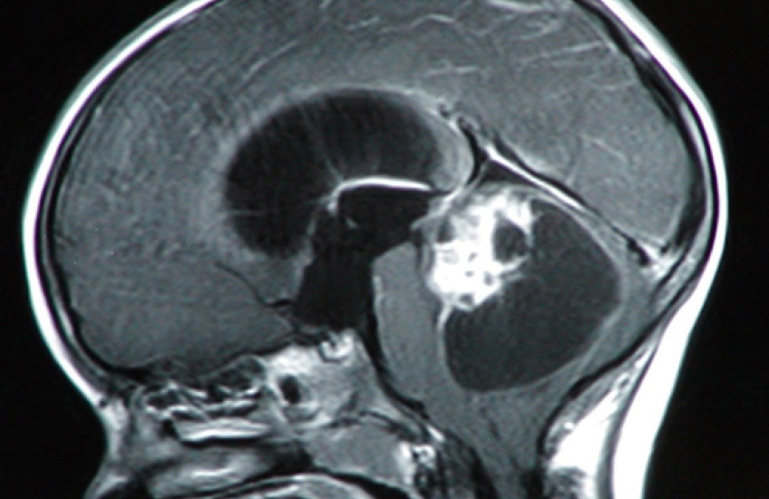 Precision Medicine Impact