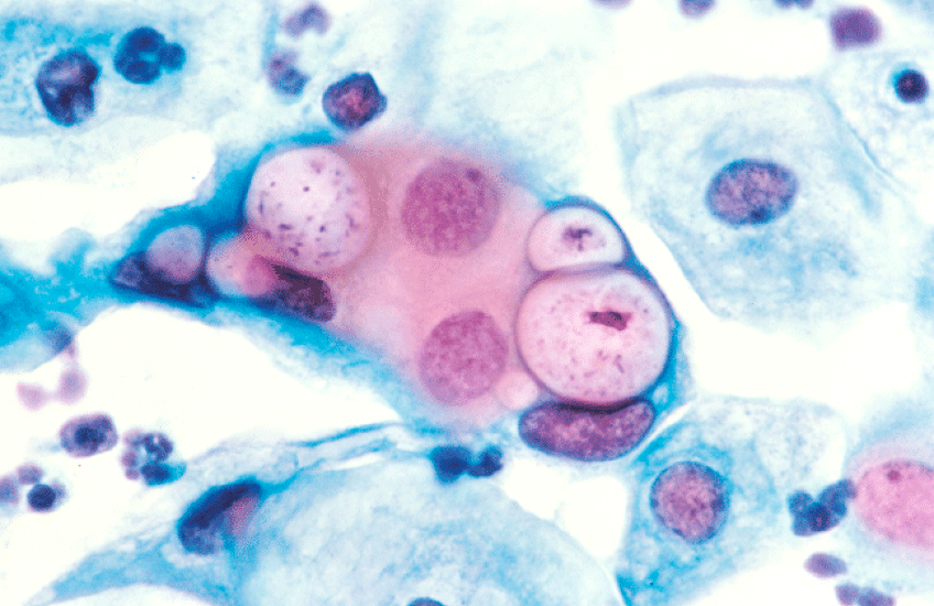 Safeguarding Against Chlamydia