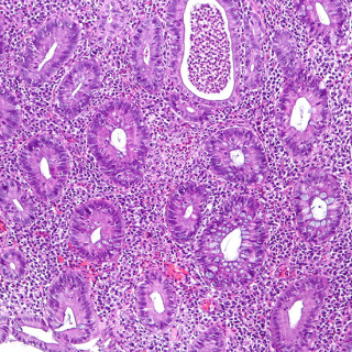 Pink- and purple-stained microscope slide shows normal and diseased features from a patient’s colon.