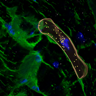 Reconstructed microscope view of cardiac cells labeled in blue and green, from a person with hypertrophic cardiomyopathy. One heart cell is outlined in orange and has many dots inside.