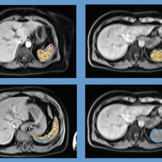 A grid of four abdominal MRI scans, with the spleen outlined in blue or marked by numerous dots added by AI.