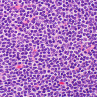 B-cell lymphoma with cells stained purple