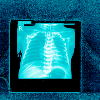 X-ray image of an intubated infant
