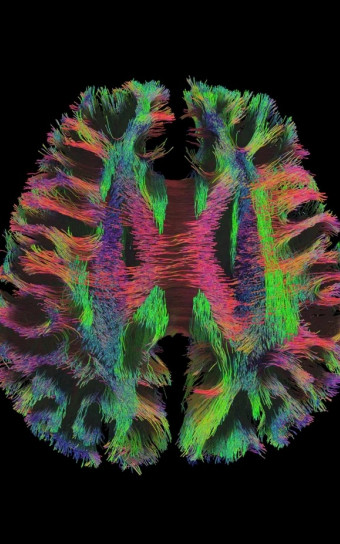 scan of the brain shows colorful interconnected threads