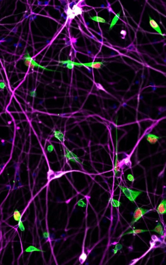 Fluorescent microscopy shows tumor cells in green, interacting with neurons in magenta