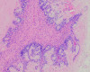 Closeup of a histology slide of a tumor, showing a pink and purple cellular structures with intricate patterns and textures.