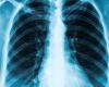 Image of a chest x-ray