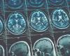 Rows of blue and white brain scans on a black background