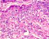 breast cancer cells
