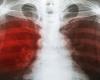 X-ray of infected lungs