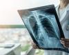 X-ray image of lungs