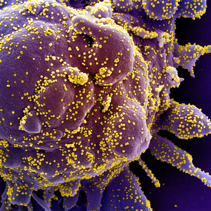 cell destroying itself after infection with SARS-CoV-2 (yellow)