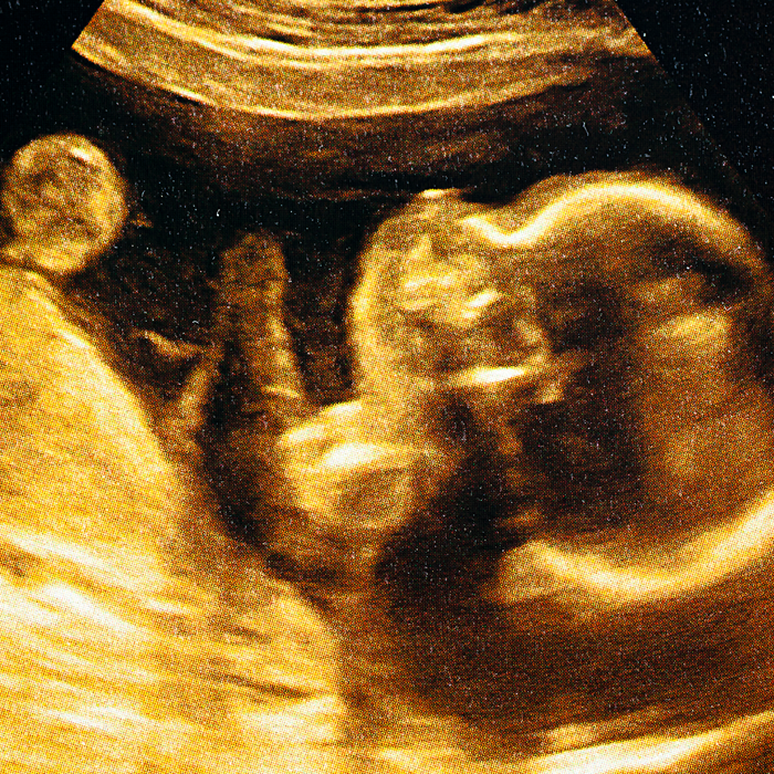 ultrasound image of a fetus