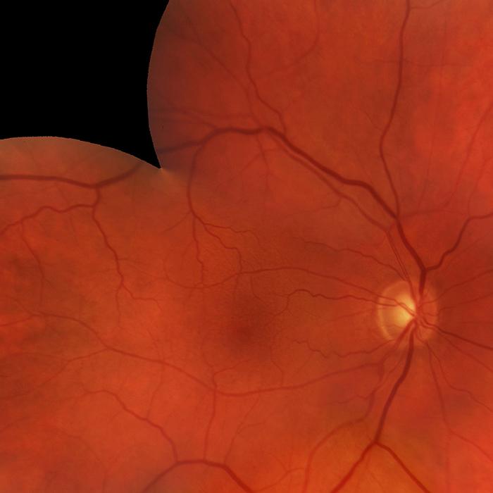 A photo of a retinal fundus showing no-to-mild diabetic retinopathy