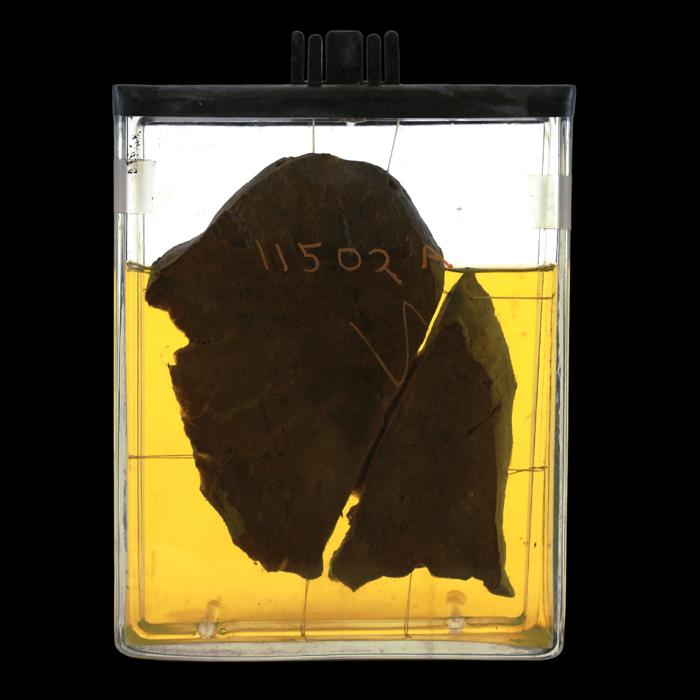 section of a lung preserved in Kaiserling's fluid, collected during 1918 flu pandemic