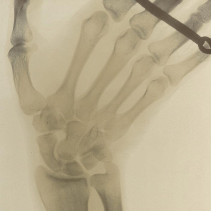 X-ray of a wrist