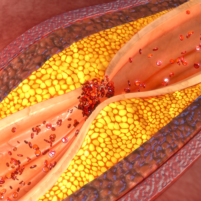 illustration of blood vessel almost fully blocked by plaque buildup
